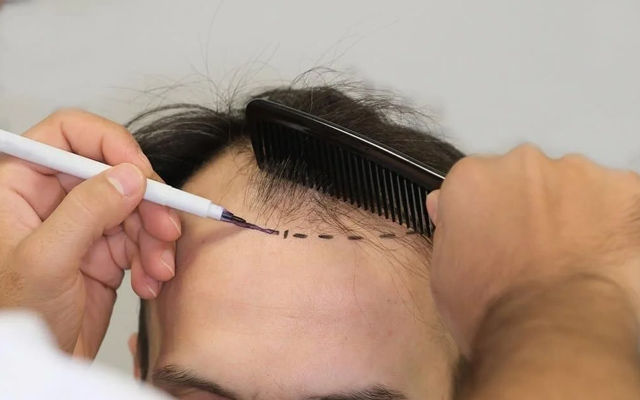 Failed PRP & Laser Hair Therapy? Why a Hair Transplant May Be the Permanent Fix You’re Looking For
