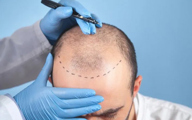 Scared of Pain During Hair Transplant? The Truth About Modern Painless Techniques