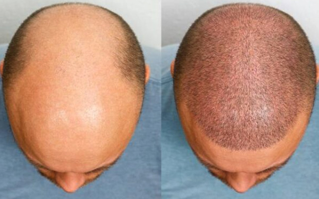 Hair Transplant Recovery Timeline