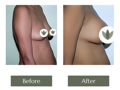 Breast Enlargement