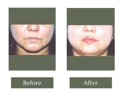 Eye & Lip Surgery, Dr. Manoj Khanna