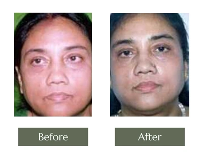 Eye & Lip Surgery, Dr. Manoj Khanna