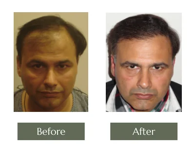 Hair Transplant, Dr Manoj Khanna