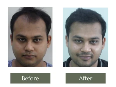 Hair Transplant, Dr Manoj Khanna
