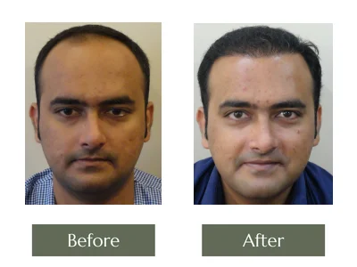 Hair Transplant, Dr Manoj Khanna