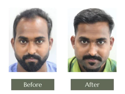 Hair Transplant, Dr Manoj Khanna