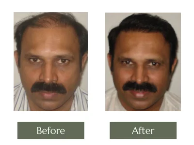 Hair Transplant, Dr Manoj Khanna