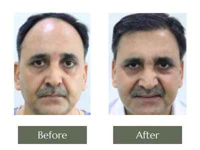 Hair Transplant, Dr Manoj Khanna