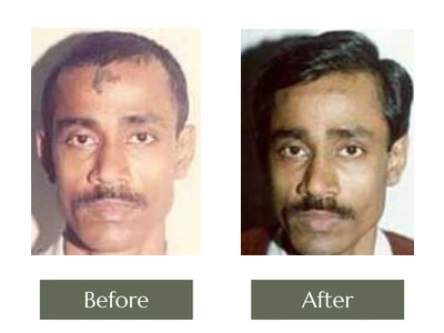 Scar & Mole Removal, Dr. Manoj Khanna