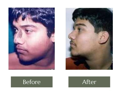 Scar & Mole Removal, Dr. Manoj Khanna