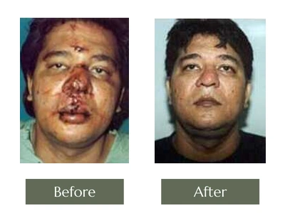 Scar & Mole Removal, Dr. Manoj Khanna