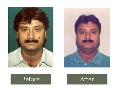 Scar & Mole Removal, Dr. Manoj Khanna
