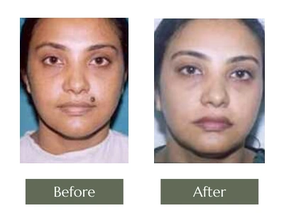 Scar & Mole Removal, Dr. Manoj Khanna
