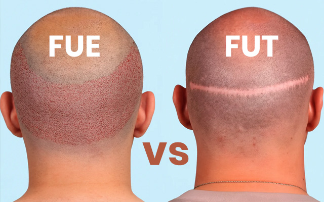 FUE vs FUT