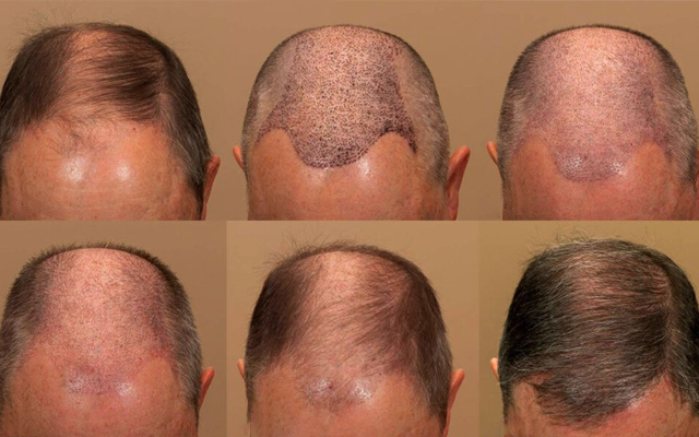 Hair Transplant Timeline