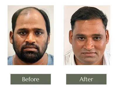 Hair Transplant Hair Transplant