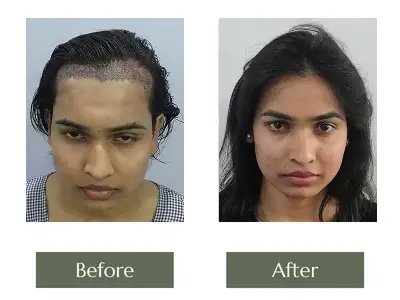Hair Transplant Hair Transplant