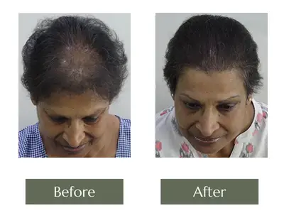 Hair Transplant Hair Transplant