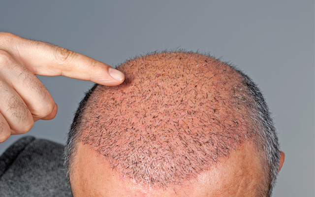 Hair transplant
