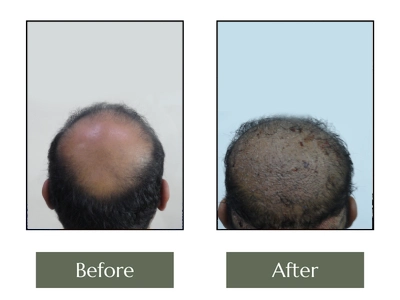 Hair Transplant
