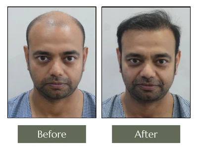 Hair Transplant